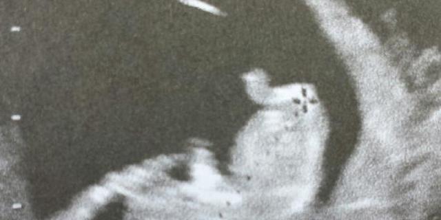 Echographie foetus