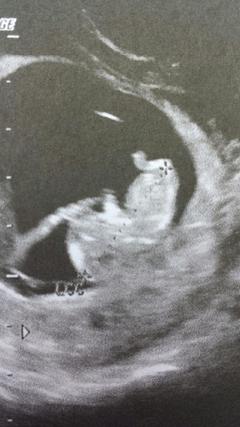 Echographie foetus
